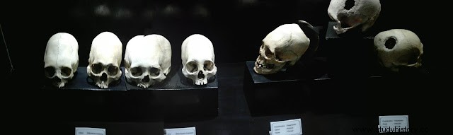 Trepanaciones en el antiguo Perú 