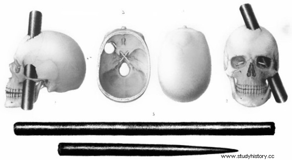 Phineas Gage:un hombre con el cráneo atravesado por una vara revolucionó la ciencia del cerebro 