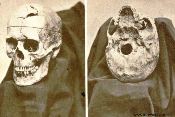 Phineas Gage:un hombre con el cráneo atravesado por una vara revolucionó la ciencia del cerebro 