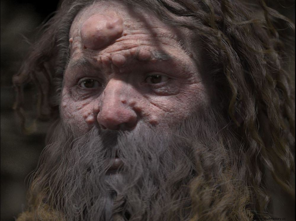 El hombre de Cromagnon tenía el rostro cubierto de nódulos 