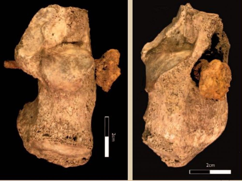 Un posible nuevo caso de crucifixión romana en las Islas Británicas 