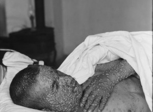 Five diseases that marked the history of humanity 